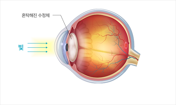 노안 눈