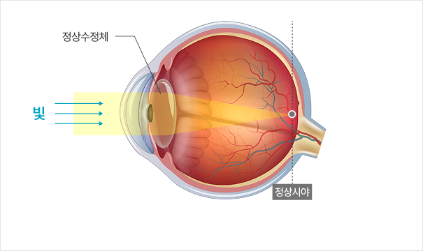 정상 눈