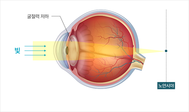 노안 눈